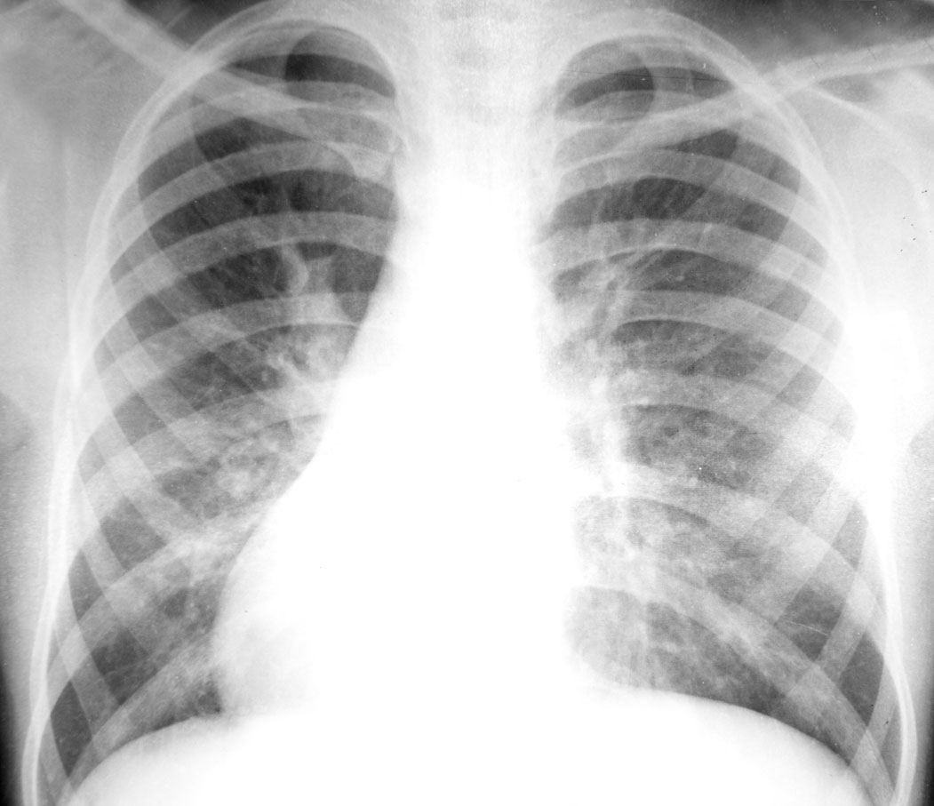 special-topics-in-TB-management